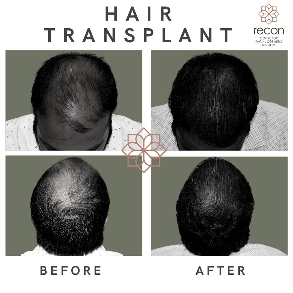 Hair Transplant in Delhi | Hair Transplant Cost in Delhi - RECON
