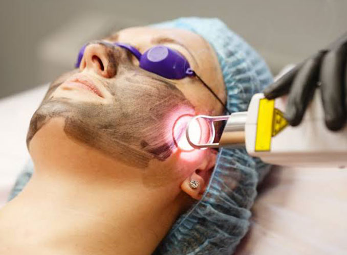 Carbon Laser Facial