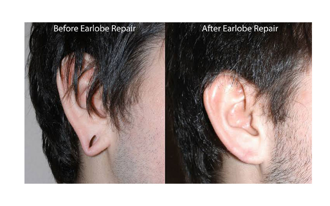 Ear Lobe Repair surgery for men