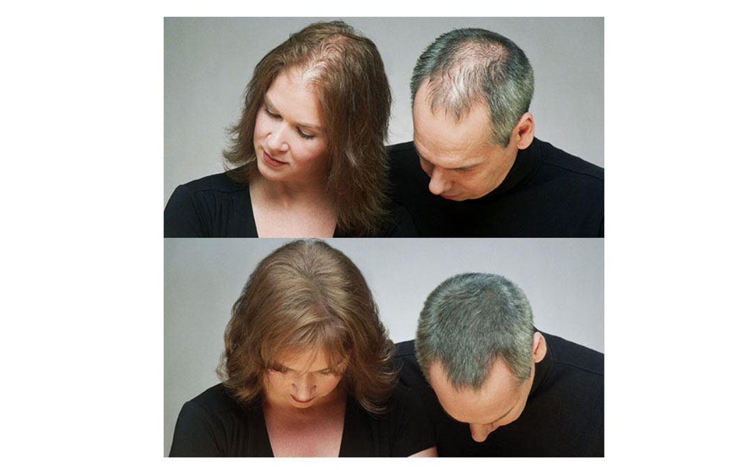 after and befor hair transplant