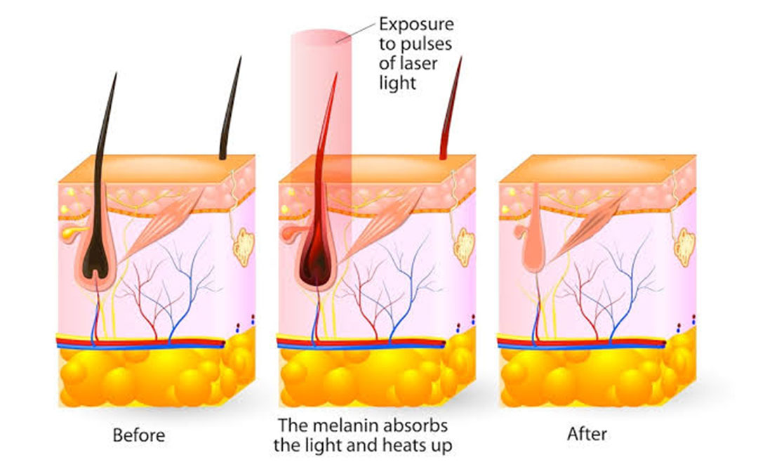 laser hair reduction mechanisms