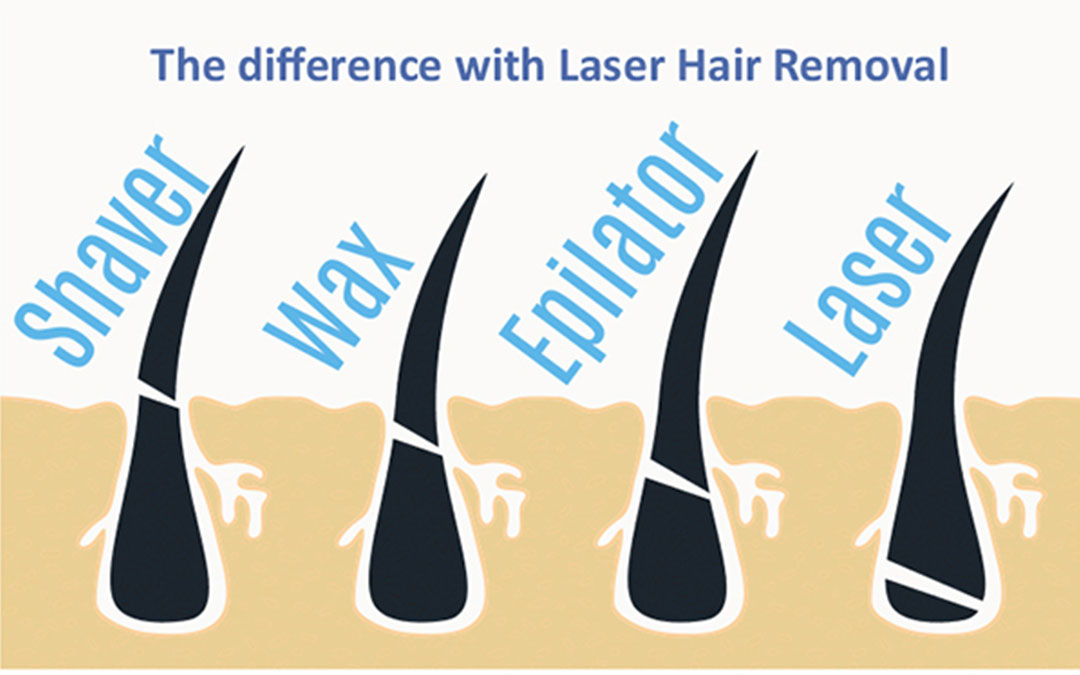 effects of laser hair removal 