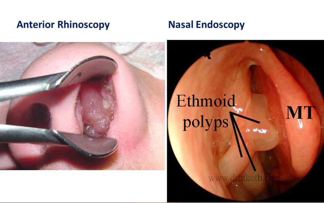 ethmoidal  Nasal Polyps