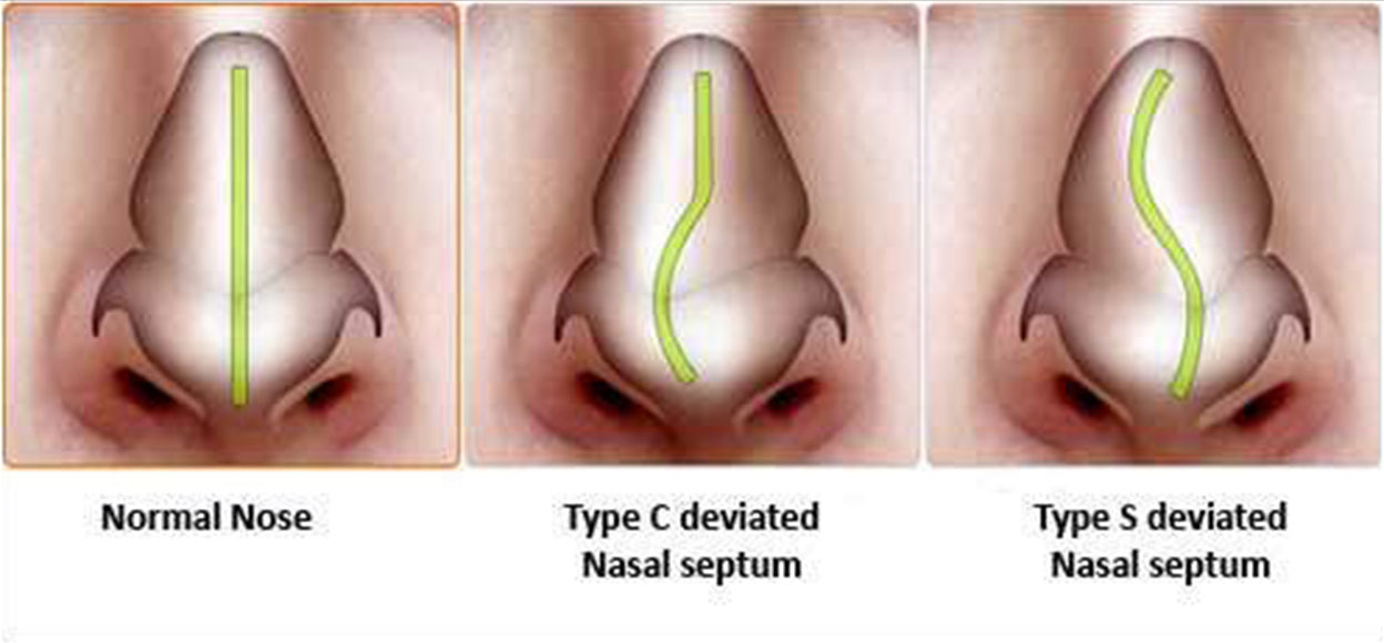 types of Deviated Nasal Septum