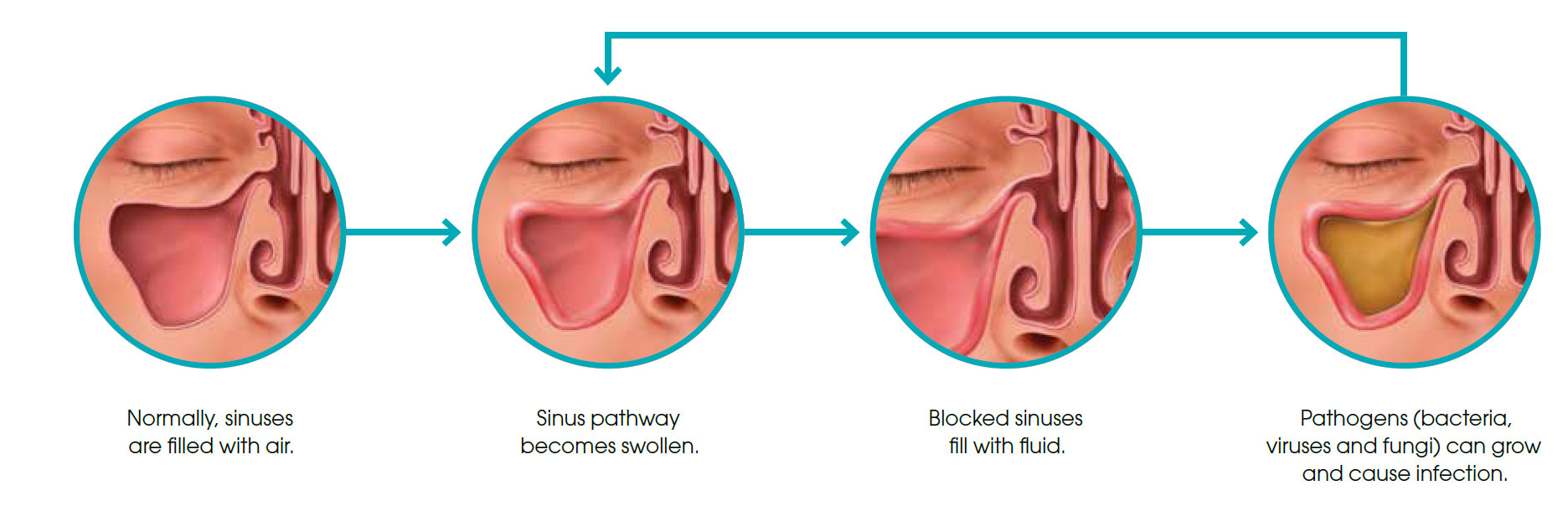causes of Sinusitis