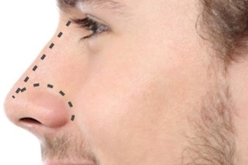 Male Rhinoplasty in Delhi, India - All you need to Know